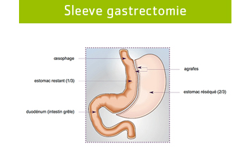 Sleeve gastrectomie